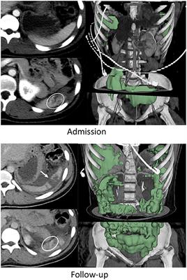 Blunt splenic injury: Assessment of follow-up CT utility using quantitative volumetry